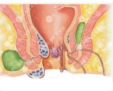 南寧哪個(gè)醫(yī)院可以做肛周膿腫？